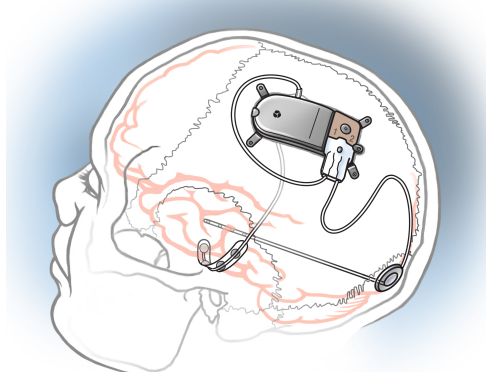 neuralink主要从事什么开发 如何进入neuralink公司工作